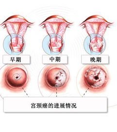 宫颈息肉