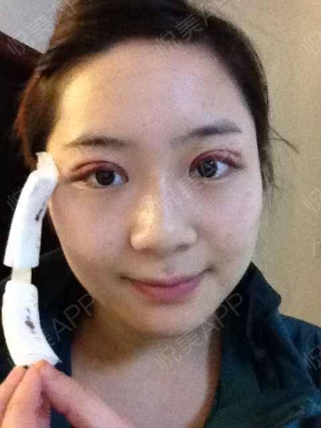 双眼皮手术及其 恢复过程