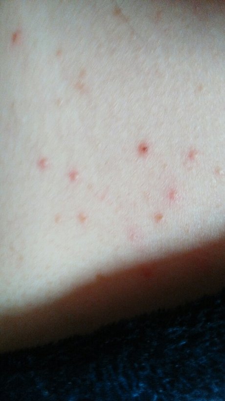 孕两个月肩膀下到胸前长了一片像痘痘样的红点,请问有什么办法吗?