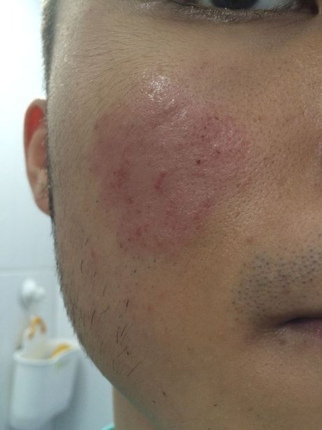相关搜索 脸部丘疹 痤疮疤痕 脸部干燥起皮 脸部瘙痒 毛周角化 皮肤
