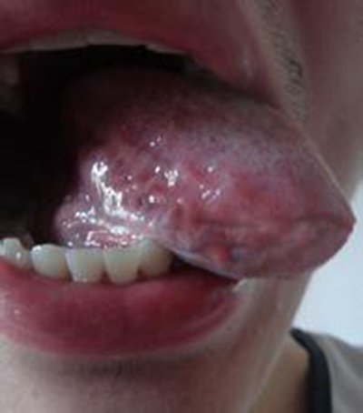 癌 初期 舌 口腔がん・舌癌は歯科口腔外科で検査することができます