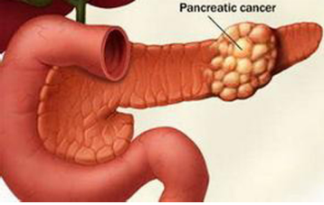 胰腺癌