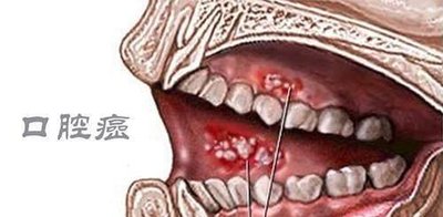 「口咽癌」已超越子宫颈癌!与 HPV 最相关的癌症,男性风险更高 - 华夏肿瘤康复网