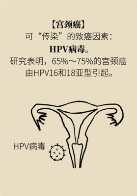 宫颈癌