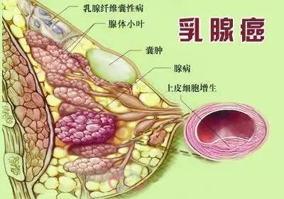 乳腺癌