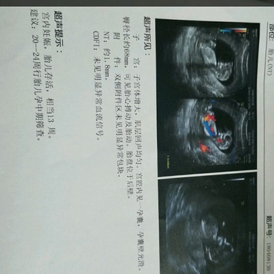 怀孕13周是孕中期吗