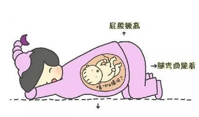 怀孕臀位怎么办