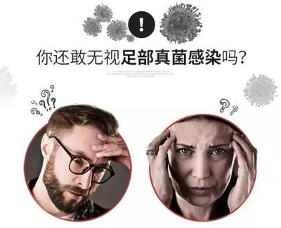 眼真菌感染怎么治疗