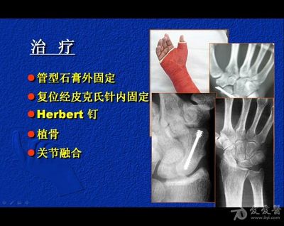 右手舟骨骨折能评几级伤残
