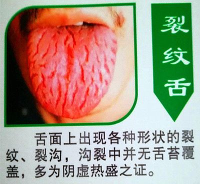 舌尖裂纹是怎么回事