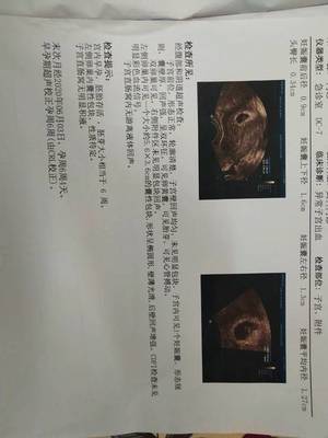 多囊怀孕