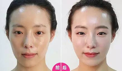 玻尿酸填充面颊