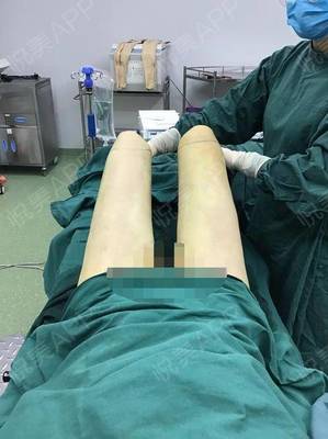 抽脂后疼痛感多久恢复