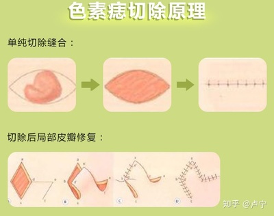 激光祛痣原理