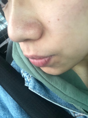 鼻子痘痘好了留下红印