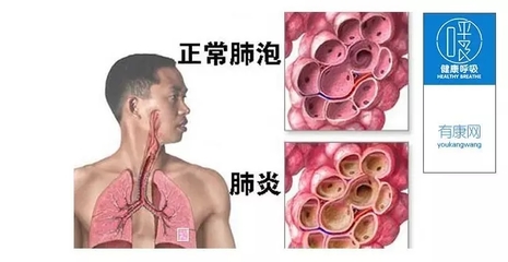 咳嗽带血丝怎么回事