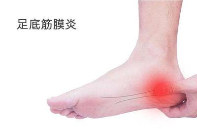 筋膜炎怎么治疗好得快