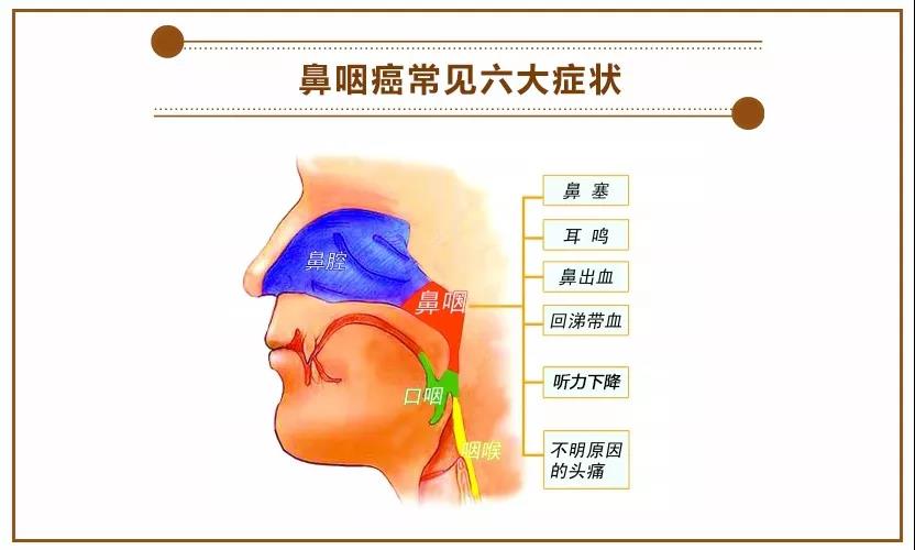 鼻咽癌