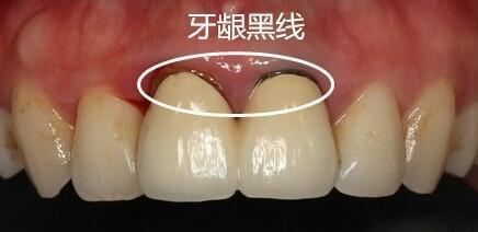 半贵金属烤瓷牙