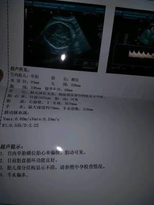胎儿心率快