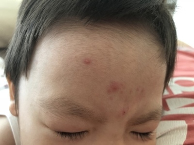 脑门长一片痘痘是什么原因