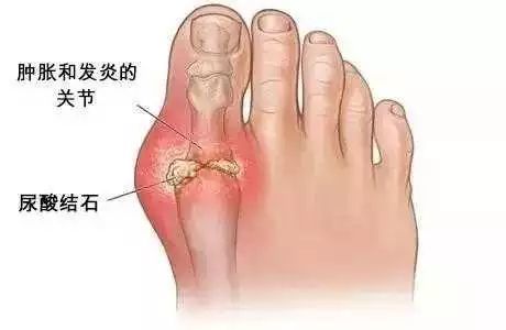 关节炎怎么治疗