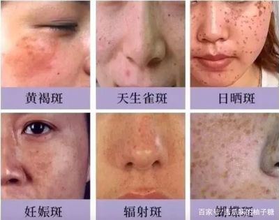 怀孕后长斑是什么原因