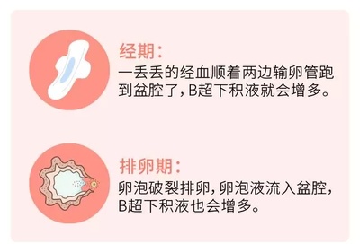 盆腔积液小肚子疼