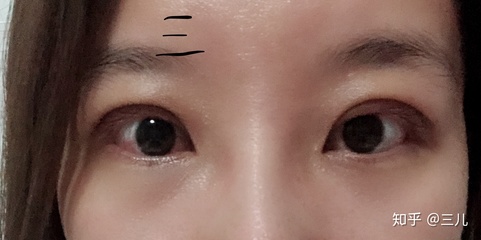 可以割一个双眼皮吗