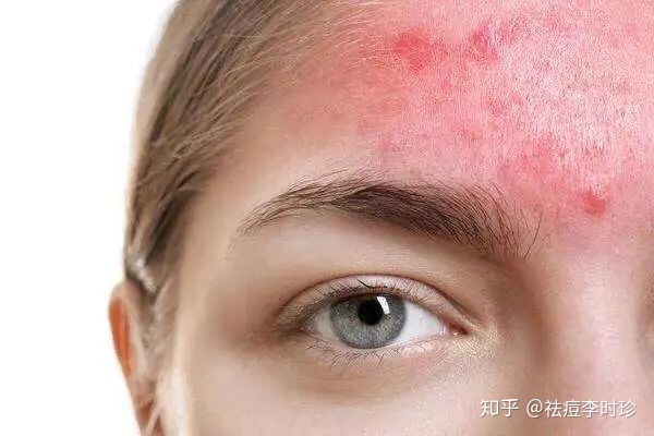 有痘痘用修复屏障