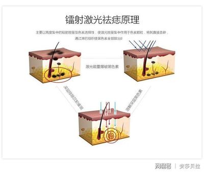 激光祛痣原理
