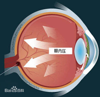 眼睛眼压高是怎么回事