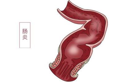 肠易激怎么治疗