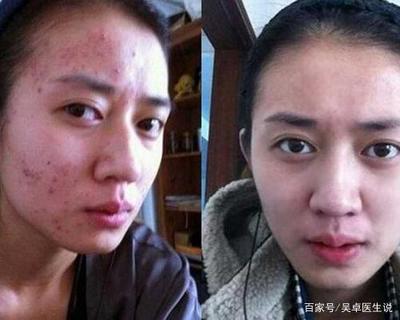 脸上长好多痘痘要怎么保养