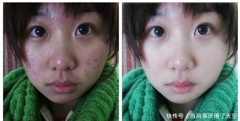 有痘痘痘印的怎么化妆