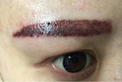纹眉后会肿吗