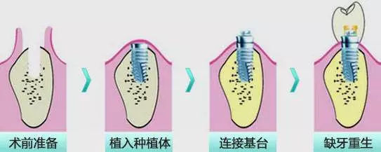种牙到底疼不疼