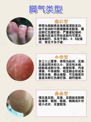 眼真菌感染怎么治疗
