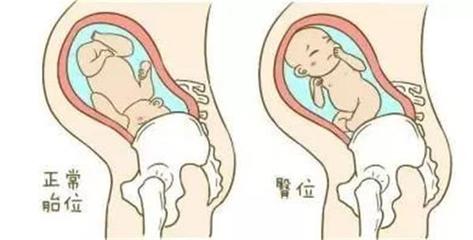 新生儿臂丛神经损伤能恢复吗