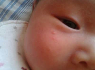 6个月宝宝出疹子症状