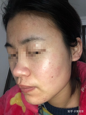 痘痘爆不出来吗