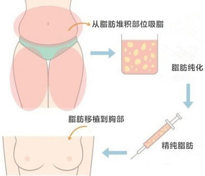抽脂的危害