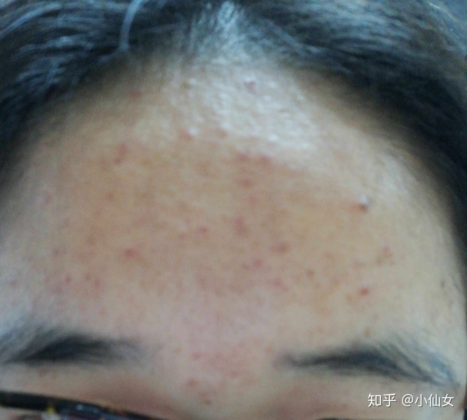 中药治疗痘痘多久见效