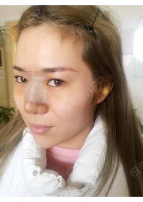 瘦脸针几天有感觉