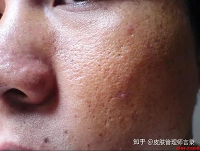 30岁痘痘一脸