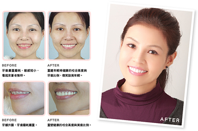 华西口腔牙齿美容冠多少钱