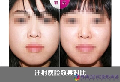 botox注射瘦脸效果