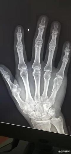 掌骨骨折算轻伤吗