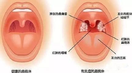 宝宝喉咙红
