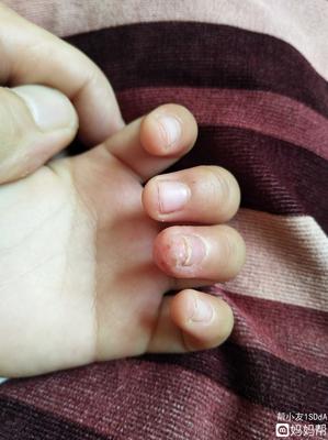 小孩手蜕皮是怎么回事